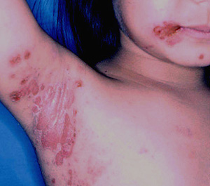 自己免疫性水疱症と口腔内びらん - みやけ内科・循環器科 総合内科のアプローチ