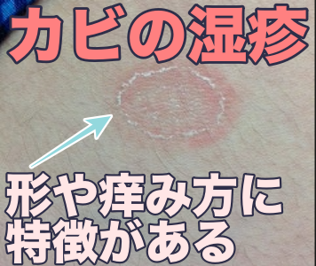 皮膚カビについてです。最初に汚い画像を乗せてしまい申し訳ございま- Yahoo!知恵袋