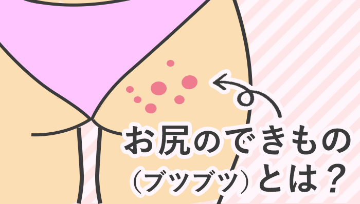 脱毛で起こる毛嚢炎について症状から予防・治療法まで詳しく解説 - ハートライフクリニック 静岡県浜松市の美容皮膚科・美容外科