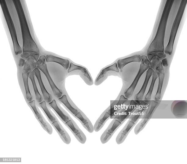手のレントゲン写真33321564 の写真素材 - アフロ