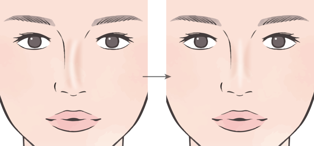 斜鼻修正術鼻整形なら湘南美容クリニック 公式