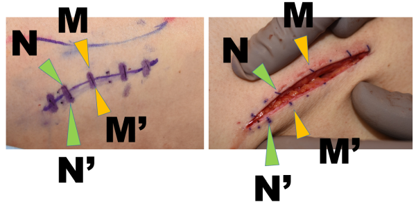きれいに皮膚を縫うコツ - 香川大学医学部形成外科・漏斗胸専門サイト「胸のかたち」研究室