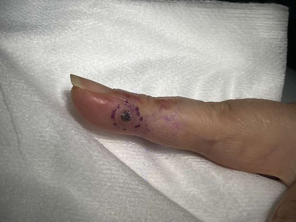 手の指先に出来たイボ 尋常性疣贅の写真素材70792897- PIXTA