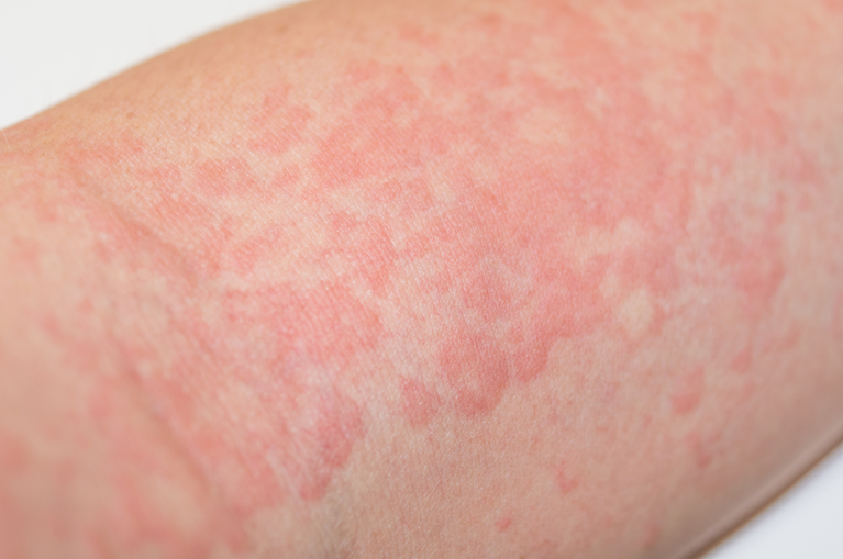 蕁麻疹 じんましんとも皮膚科クリニック高崎市の皮膚科・アレルギー科