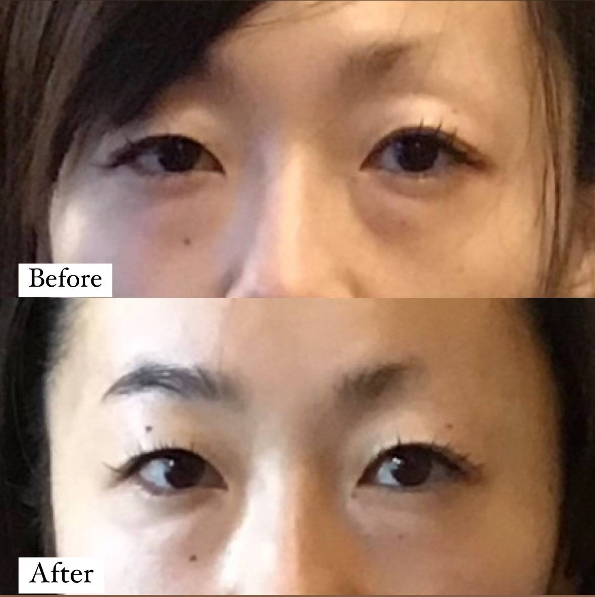 雄雌眼とは？目に左右差が出る原因や改善方法を詳しく解説🌿HAABクリニック 公式