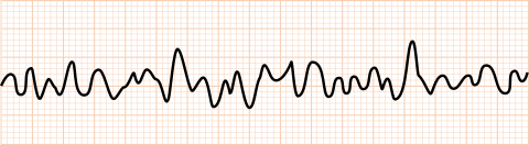 心肺停止 CPA の心電図波形看護roo! カンゴルー