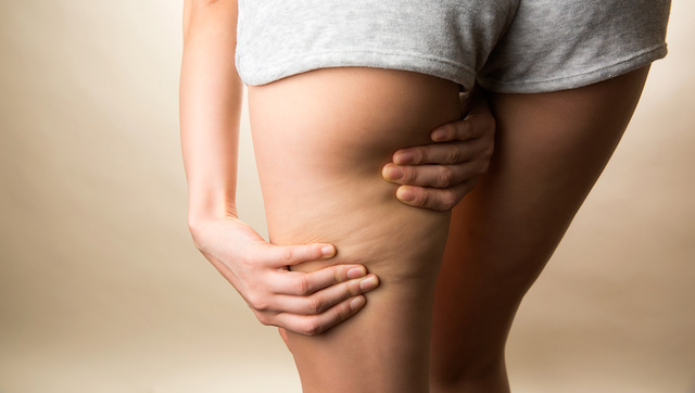 二の腕のセルライト解消法を解説！安全・確実に除去できる方法も紹介セルライトのススメ