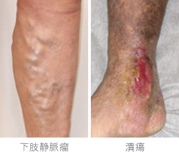 知っトク！高齢者の足のむくみつつみ内科・脳神経内科・リウマチ科