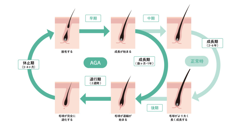 図解 ヘアサイクルの仕組みと悪化する理由～回復しないときの対処法抜け毛・薄毛のお悩み