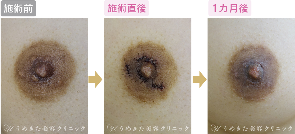 乳首の毛 乳輪毛 は抜いて処理？ケア方法 - 夜の保健室コラム よるほけ