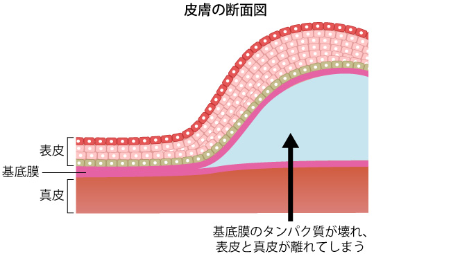 糖尿病による皮膚トラブルを回避するためのフットケアとは？やり方を紹介
