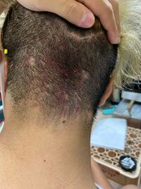 頭皮ニキビの原因と治療法を紹介！できやすさに男女差はある？ハダメディア by BIHADADO.TOKYO