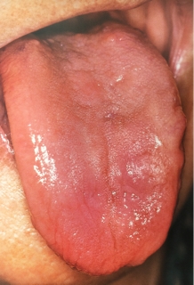 舌がひび割れしてる？考えられる原因や対策について解説します！ - 口腔外科DOC