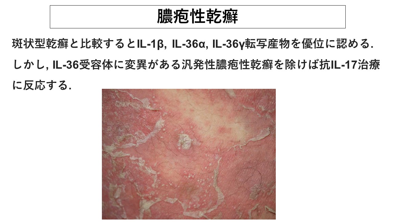 膿疱性乾癬 汎発型指定難病３７– 難病情報センタ