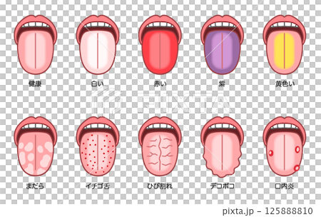 舌の苔をとってはいけない人の話。養生法と漢方植松光子