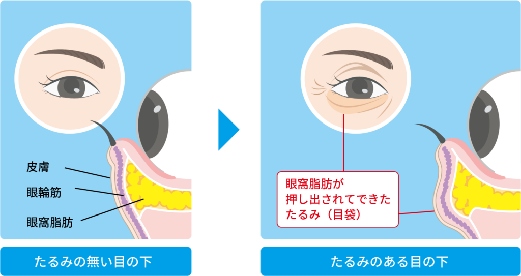 目の下のたるみ・クマを自力で治す方法は？3分で簡単にできるセルフケアを紹介美容整形はTCB東京中央美容外科