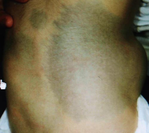 腰部の異所性蒙古斑。生後3か月女の子。 - ドクターリコの明日もＨａｐｐｙ