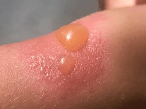 日焼けによる皮むけはむいてはいけない！ケアをしないとシミやくすみの原因に