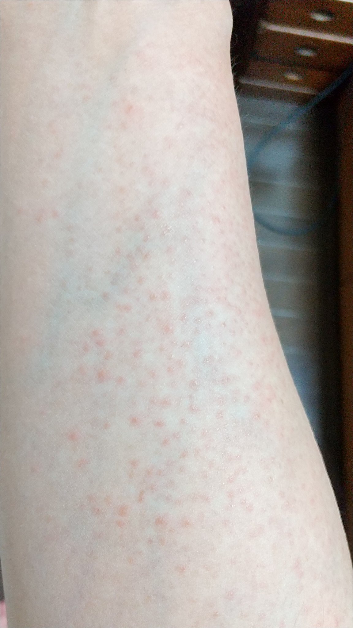 漢方薬による紅班の改善例漢方薬相談・漢方百科イスクラ薬局