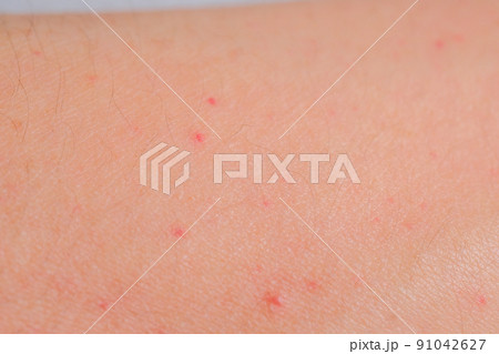 多形滲出性紅斑 たけいしんしゅつせいこうはん の原因と治療法 ステロイド あさ美皮フ科亀戸駅前