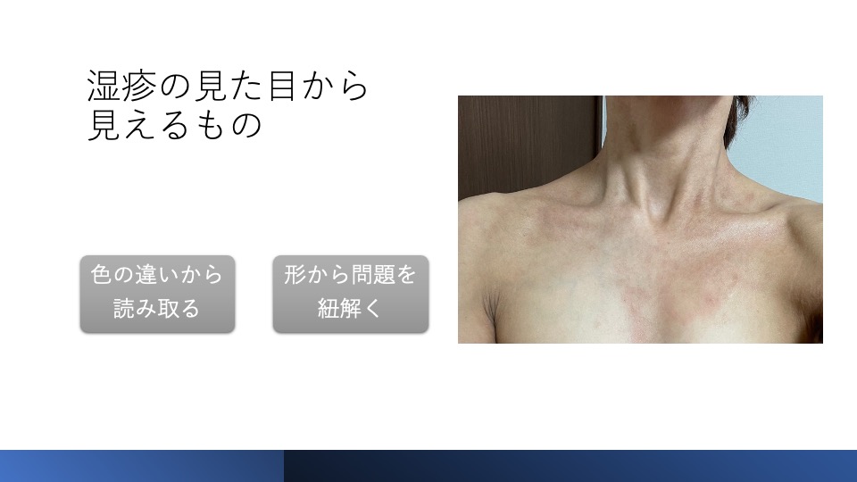 胸に帯状に部分的にみられる湿疹野田市 小児科 千葉県 こどもの花粉症 こどもの漢方 喘息 アトピー性皮膚炎 アレルギー 結節性痒疹たんぽぽこどもクリニック