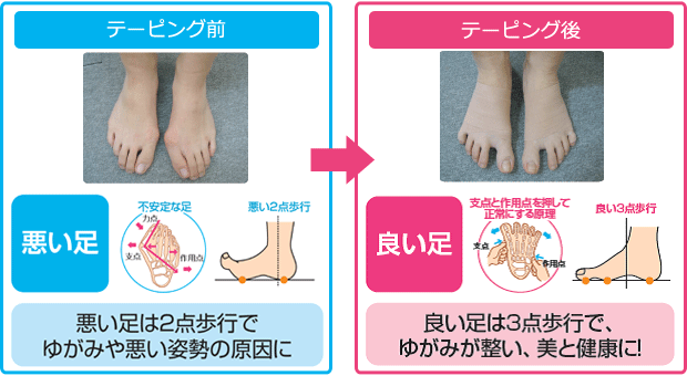 脛 すね の外側が痛いときの改善法 - 姿勢改善専門エーパシ カイロプラクティック久留米市の整体