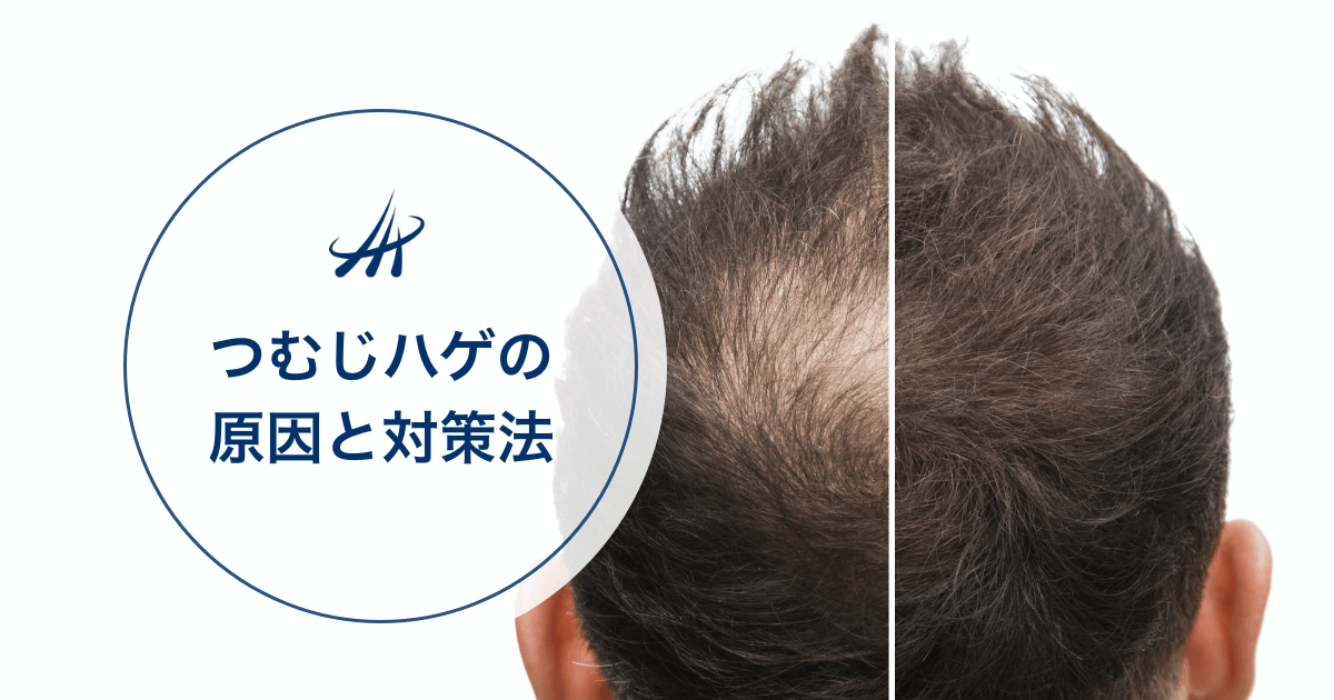 すみません助けてください高校生男子ですが生え際が後退したり髪と髪- Yahoo!知恵袋