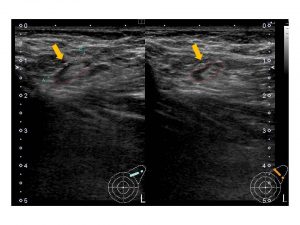 リンパ節炎 りんぱせつえん 家庭の医学時事メディカル時事通信の医療ニュースサイト