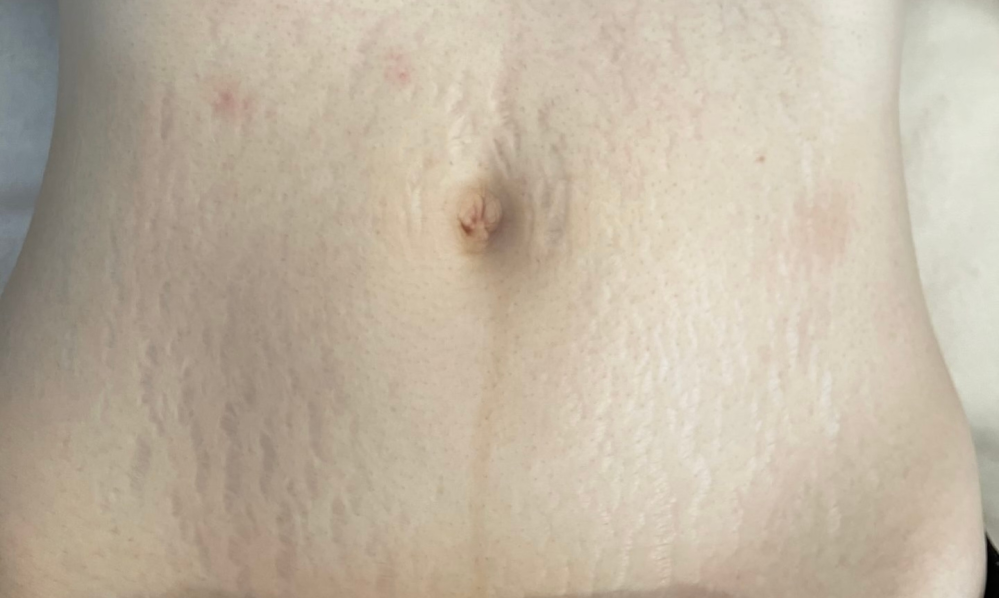 妊娠線が辛いです。２６歳の一児の母です。 - 私は元々お腹がふっ- Yahoo!知恵袋