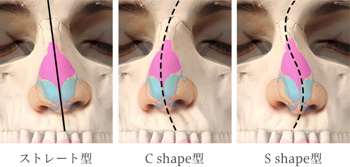 斜鼻修正術曲がった鼻を真っ直ぐにする手術奈良 樹のひかり形成外科・皮ふ科