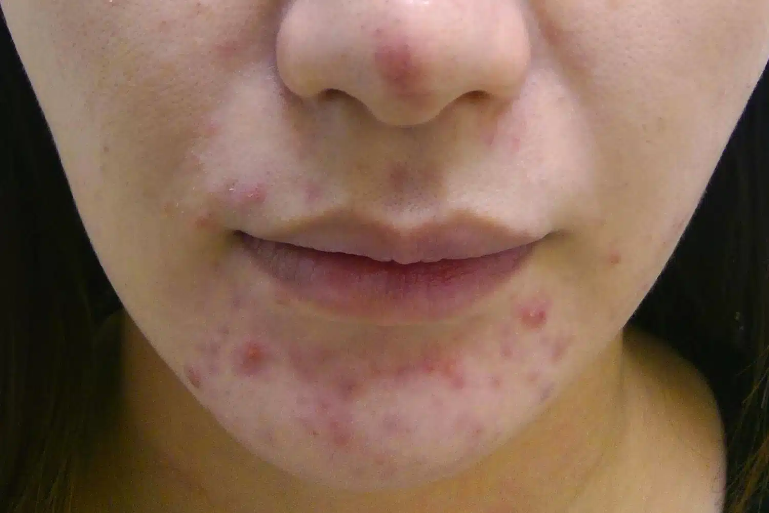 ほうれい線 ・ニキビ跡 ・顔の傷跡 ・額のシワ ・水疱瘡の跡 ・マリオネットライン ・目頭切開の跡 ・口唇口蓋裂 などなど顔の凹んだ傷跡・深いシワにお悩みの方、陳整形外科の ジュブゼン自己真皮再生術 で！！！ ご相談・ご予約は、 日本語ライン相談 ID:drchin777