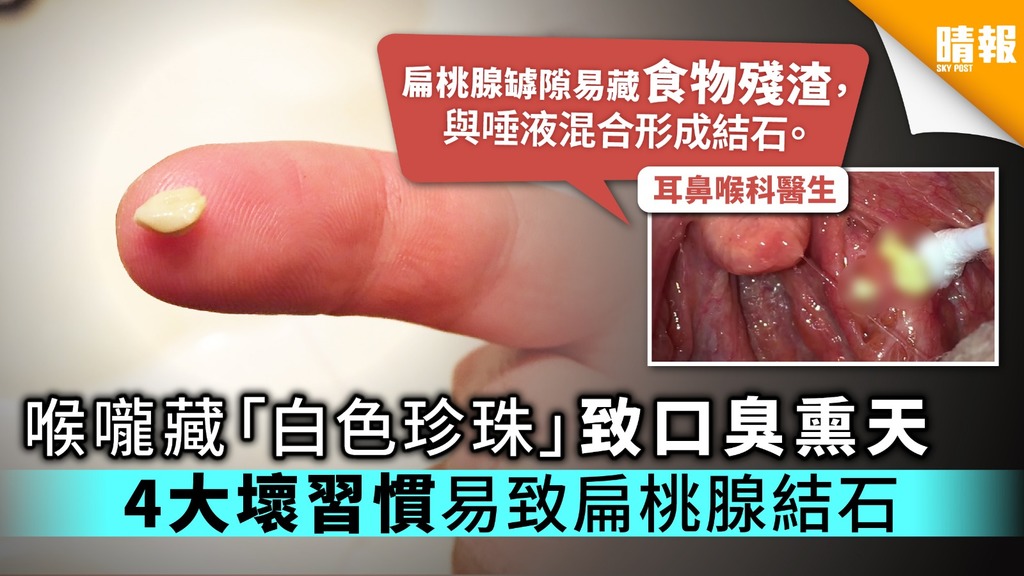 ORAVIX 口腔洗浄フロッサー 敏感な歯と歯茎 口臭でお悩みの方に 膿栓除去キット 扁桃結石 臭い玉 電源・電池不要 正規品 膿栓洗浄