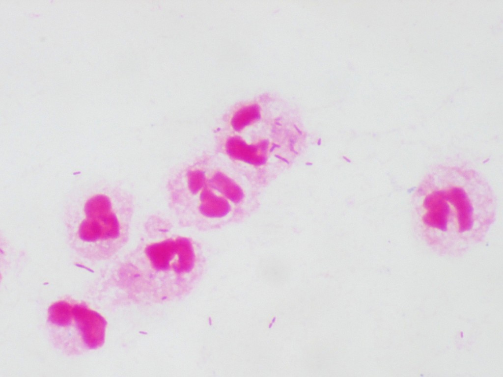 炎症性粉瘤について - 大阪梅田形成外科粉瘤クリニック