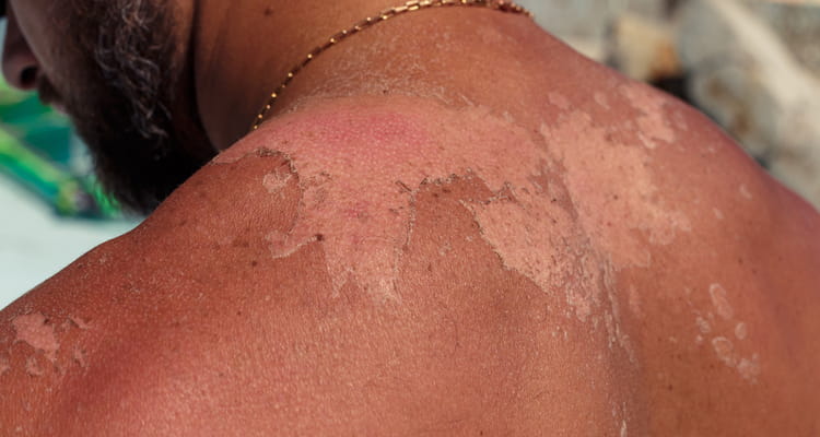 思いがけぬ日焼け後のアフターケアとおすすめケアアイテムNONN