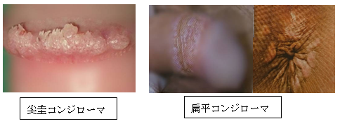 尖圭コンジローマについて性病専門のあおぞらクリニック新橋院