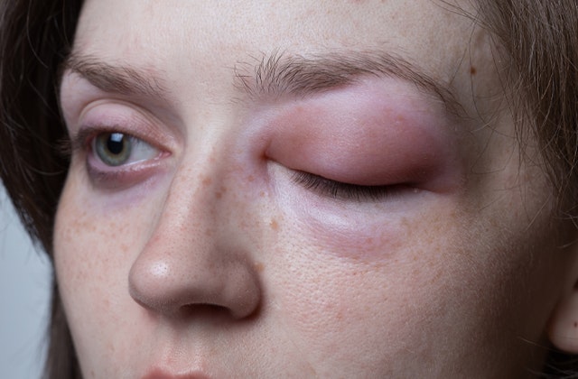 血管性浮腫 クインケ浮腫だいだいだい好きな宝物