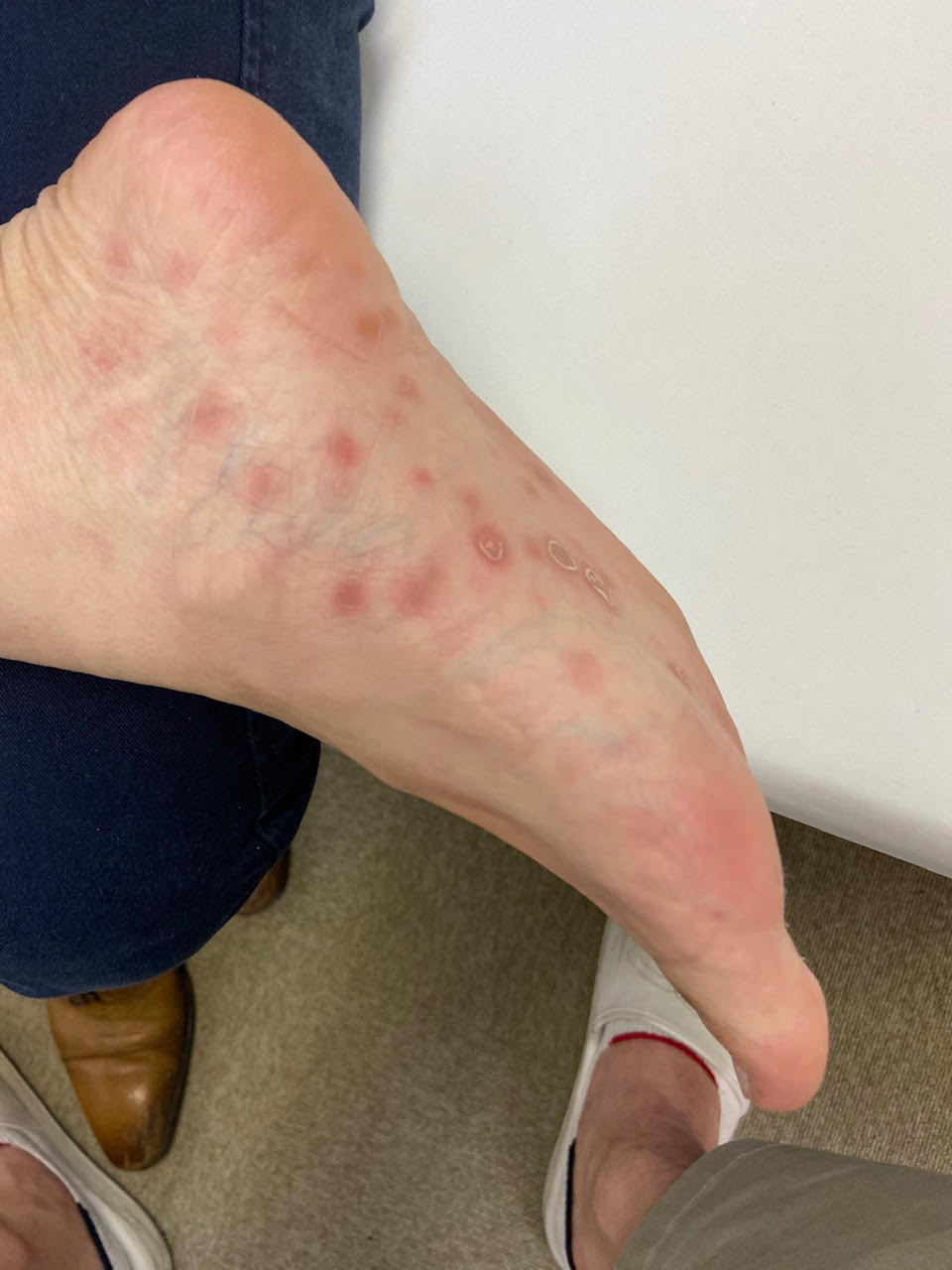 梅毒」何年もかけて進行する恐ろしい病気 感染急拡大のワケ、ピンク色「発疹」手のひらの「カサカサした斑点」性行為など性器・口の粘膜接触で感染、本当の怖さを知らない世代が増加SBC NEWS長野のニュースSBC信越放送1ページ