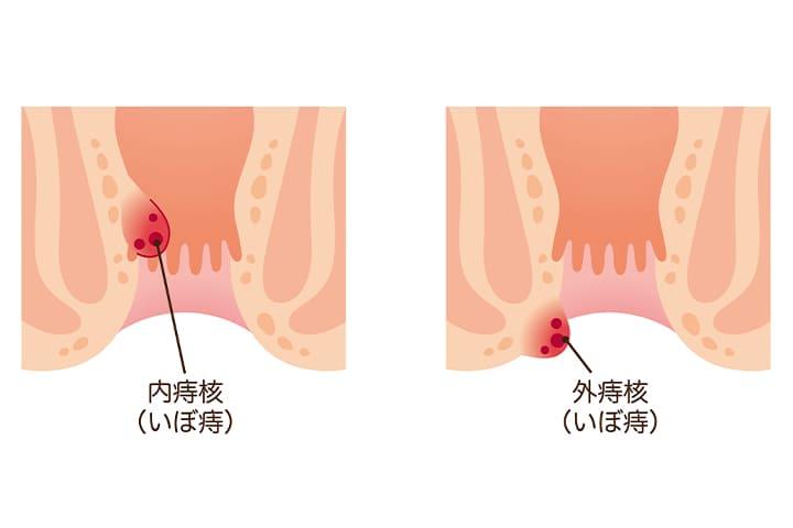 手術動画と写真：痔の日帰り手術八王子駅北口から徒歩6分の肛門外科・八王子クリニック本院東京都八王子市