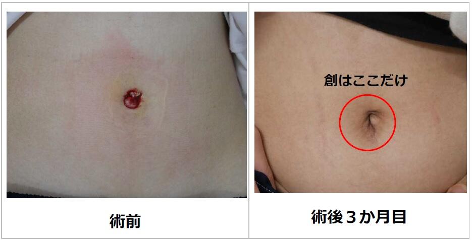 おへそからベタベタ液体がでる、痛みがある!?臍炎の2つの主な原因・3つの合併症 – いしゃまち