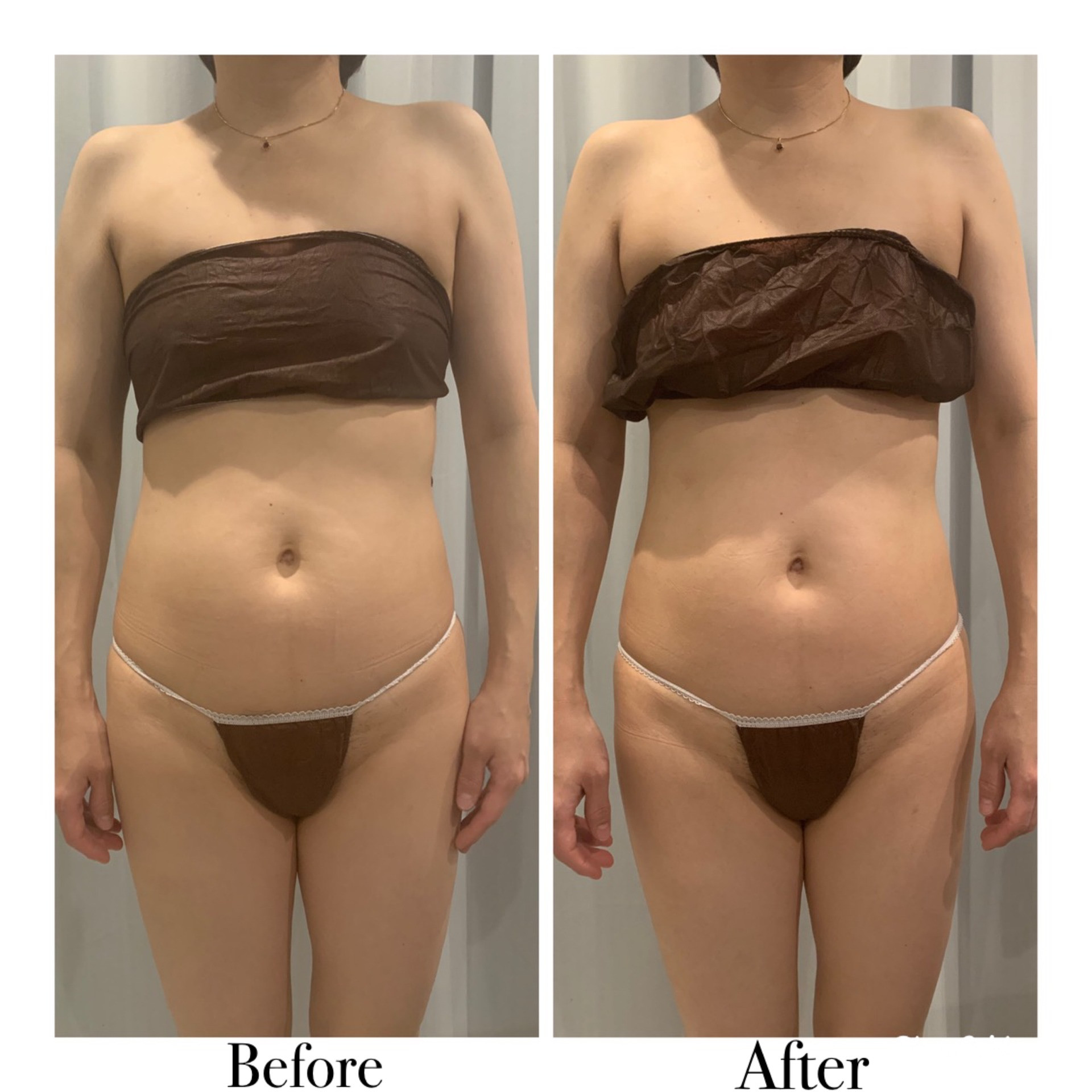 男性の脱毛の効果のお写真です😜 脚、腕、腰の３つの部位全て2回目の変化になります！ 全ての部位で脱毛の効果が驚くほどでています🩵💛まだ今からでも間に合います！！脱毛を始めてみて快適な夏を過ごしてみませんか🌺✨？ 🌱山梨県甲府市横根町454-1 グランシードKO A