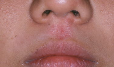 それって本当にニキビ？鼻にできたデキモノの正体について解説ニキビ・ニキビ跡治療のKM新宿クリニック