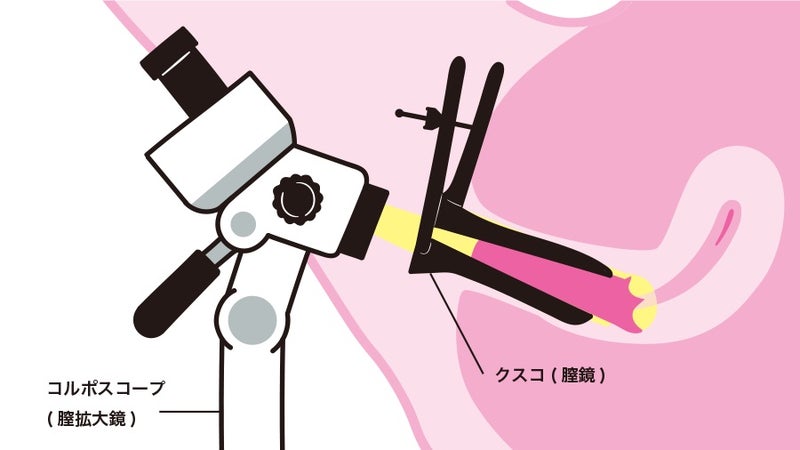 子宮頸がんの検査・診断国立がん研究センタ