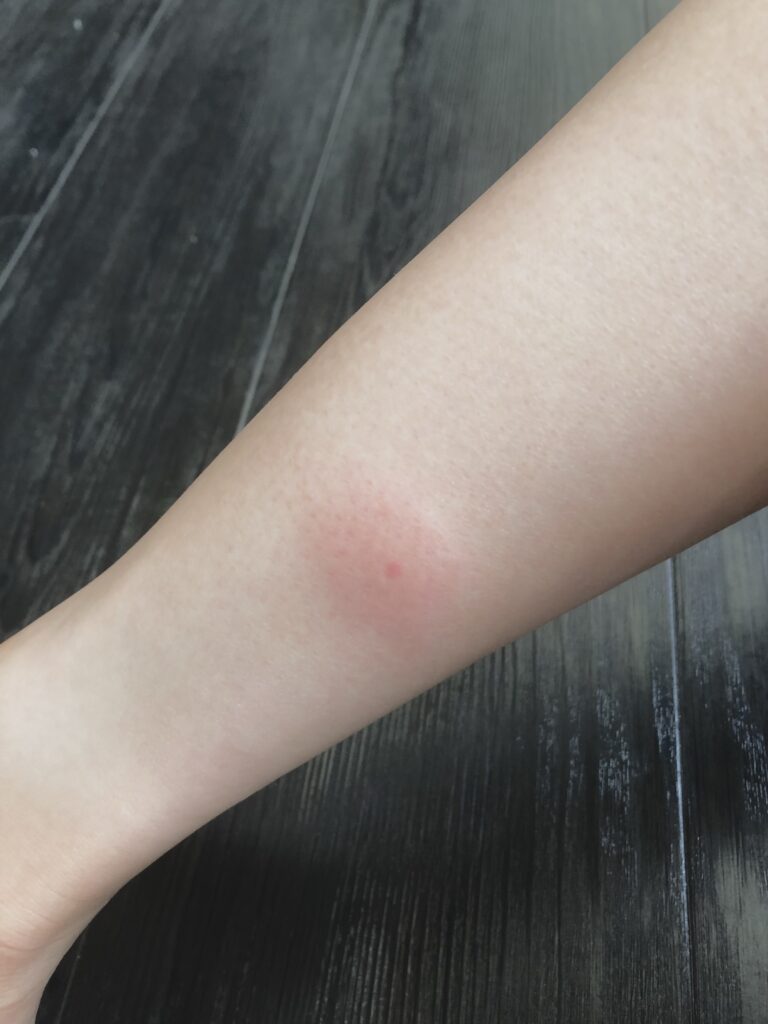 夏は「ブヨ」に注意！刺されたら？刺されないための対策は？小菅村総合情報サイト こ、こすげぇ