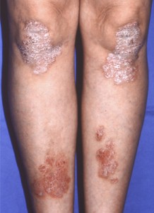 乾癬の種類乾癬パートナーズ