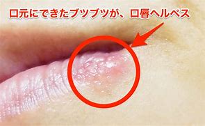 唇のブツブツ：フォアダイスの原因・治し方・予防等について - 美容外科船橋中央クリニック&青山セレスクリニック