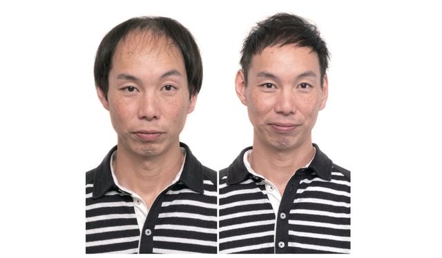 頭頂部の薄毛はげがバリカン坊主に！薄毛はげでもカッコイイおしゃれ坊主