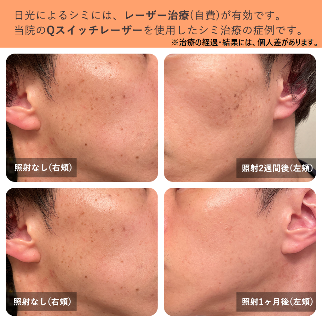 シミ取りレーザー後のケア横浜市鶴見の形成・美容外科 エムズクリニック