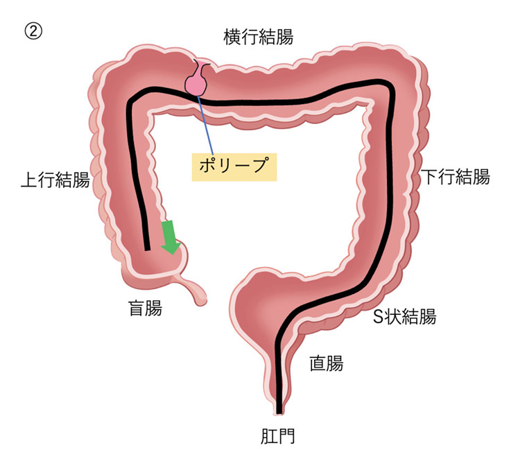 大腸ポリープ切除後の合併症リスク たまプラーザ南口胃腸内科クリニック 消化器内視鏡横浜青葉区院