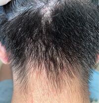 治癒した10代の少年の後頭部にきび、肩の10代のにきびの傷跡、皮膚の感染症、男性の体へのアレルギー、ヘルスケアと医療のコンセプト。の写真素材・画像素材Image 197508027