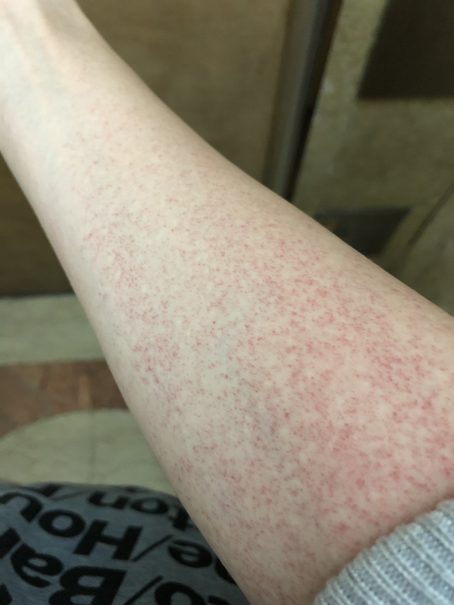 打撲と甘くみてはいけない 緊急手術の可能性もあるコンパートメント症候群の原因と治療法枚方市の整体・整骨院なら鍼灸整骨A.T.NAGASHIMA